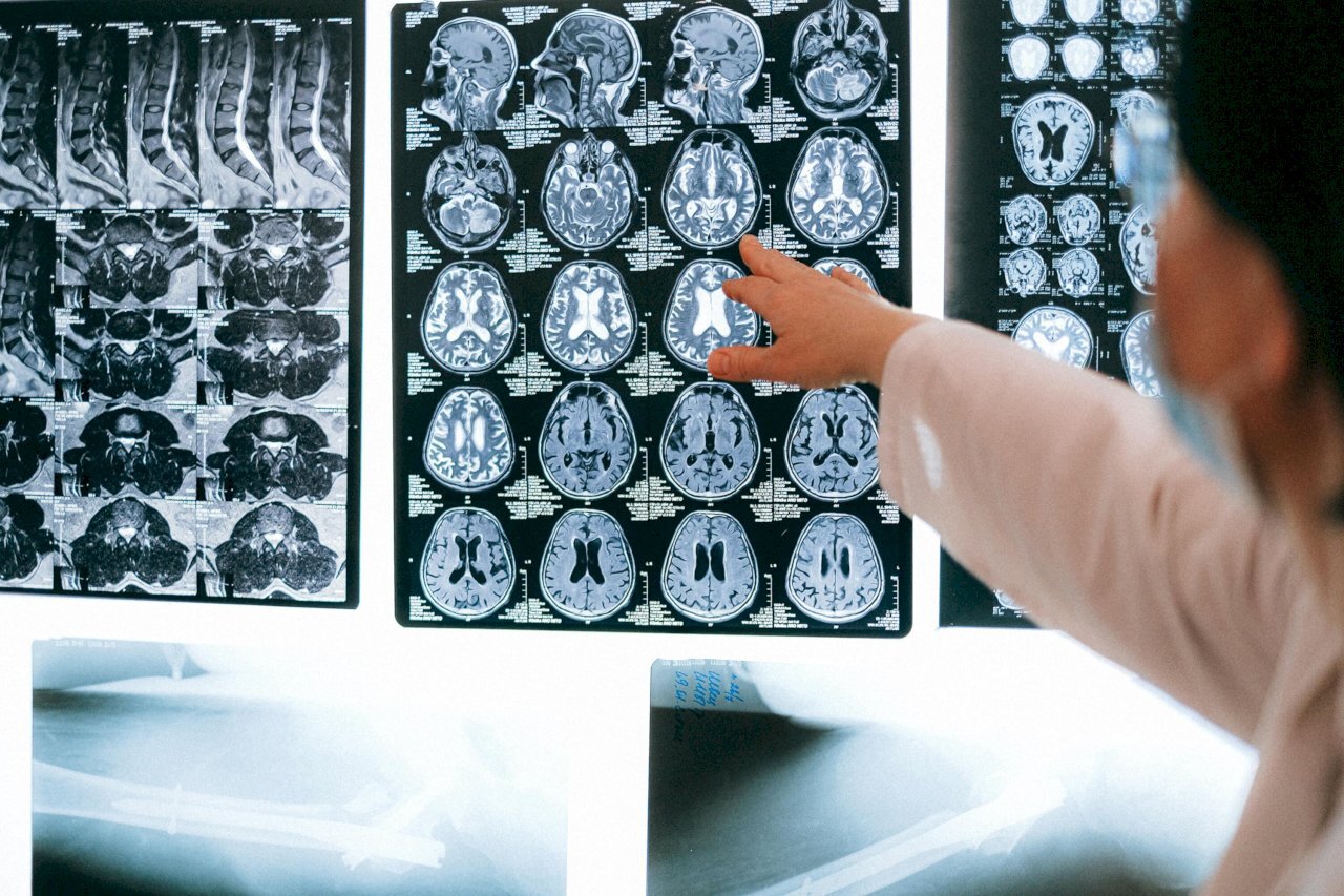 Ang pangalawang bagong gamot na Alzheimer ay nagpapatunay na mabisa sa pagbagal ng paghina ng cognitive