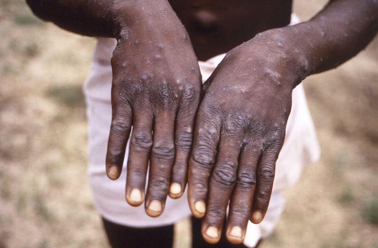 Pagdami ng Kaso ng Mpox: Africa Nagdeklara ng Public Health Emergency