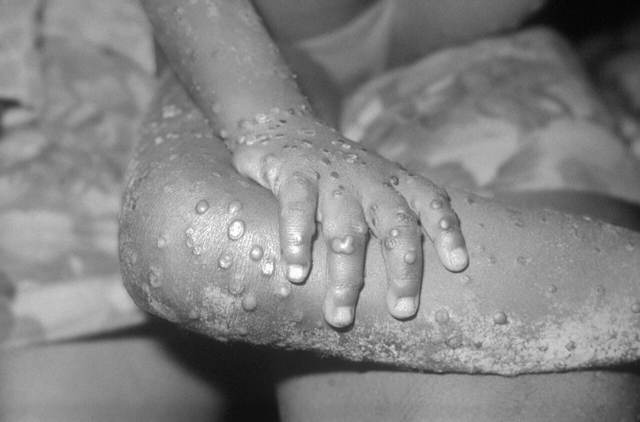 Ang kabuuang bilang ng mga kaso ng M-pox sa Brazil ay halos 1,000, higit sa kalahati nito ay puro sa estado ng Sao Paulo